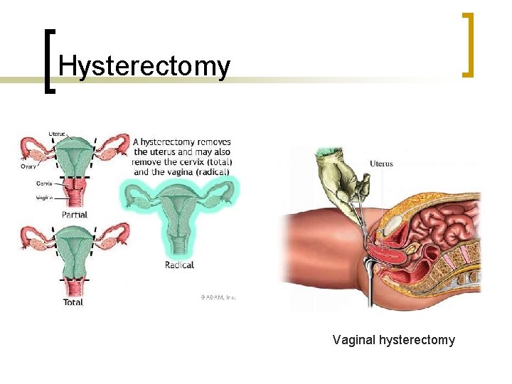 Hysterectomy Vaginal hysterectomy 