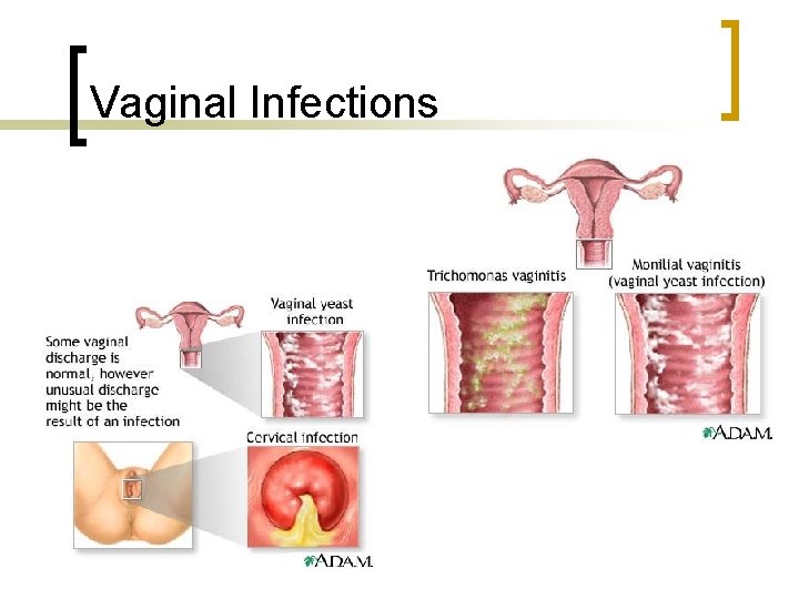 Vaginal Infections 