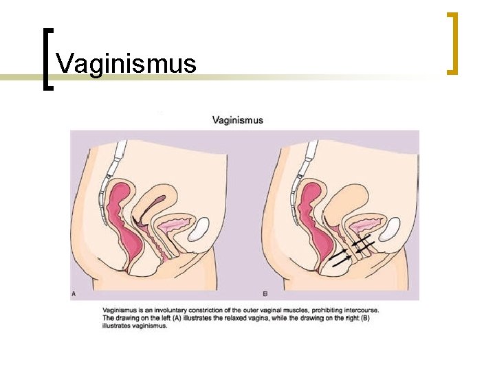 Vaginismus 