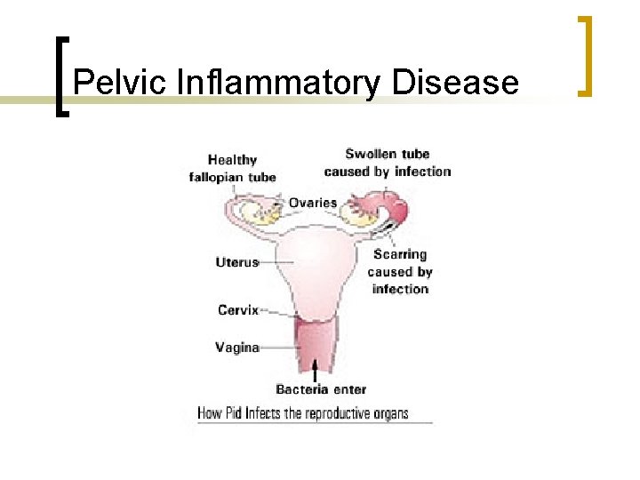 Pelvic Inflammatory Disease 