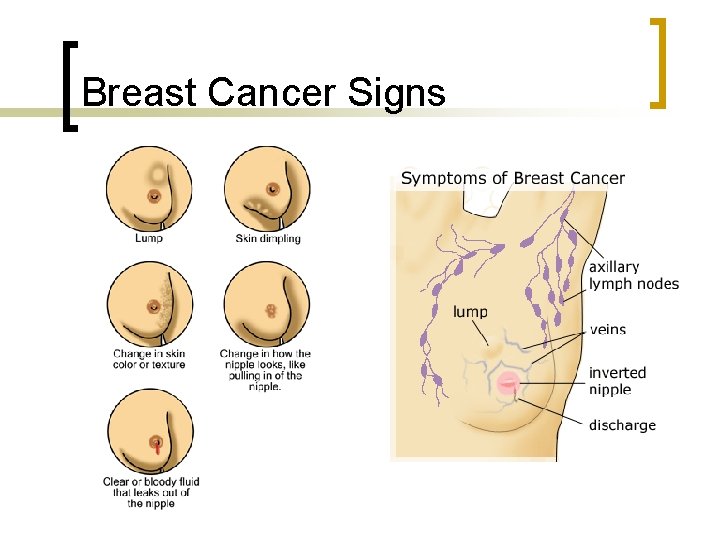 Breast Cancer Signs 