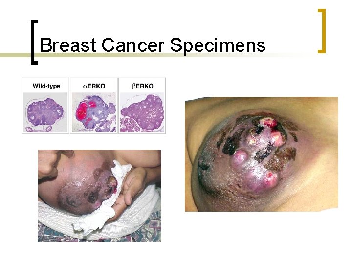 Breast Cancer Specimens 