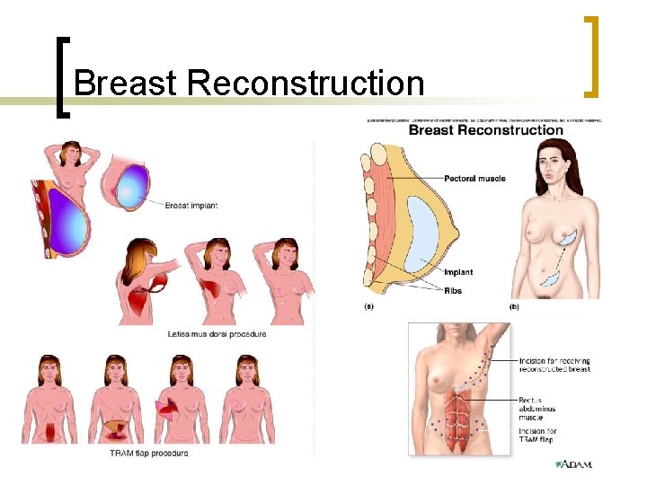 Breast Reconstruction 