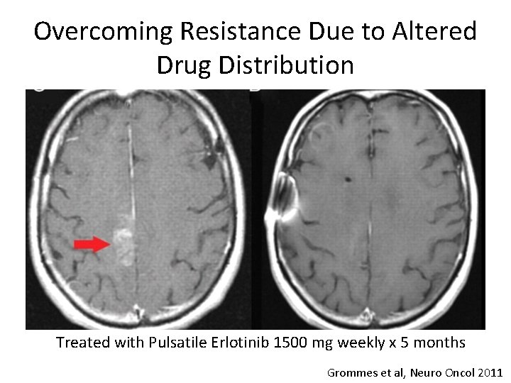 Overcoming Resistance Due to Altered Drug Distribution Treated with Pulsatile Erlotinib 1500 mg weekly