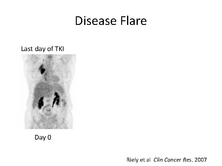 Disease Flare Last day of TKI Day 0 Riely et al Clin Cancer Res.