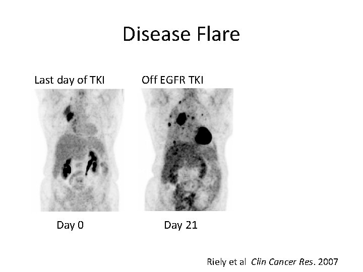 Disease Flare Last day of TKI Day 0 Off EGFR TKI Day 21 Riely