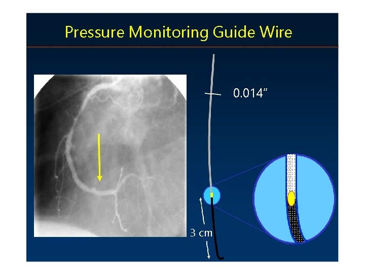 Pressure Monitoring Guide Wire 0. 014” 3 cm 