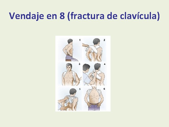 Vendaje en 8 (fractura de clavícula) 