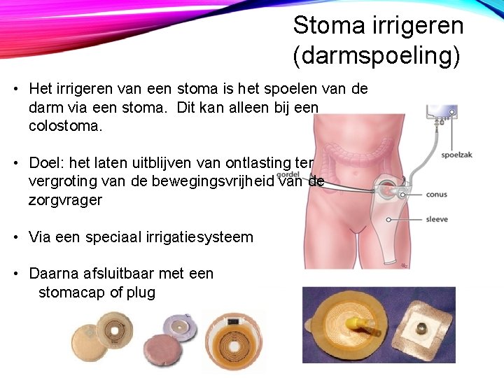 Stoma irrigeren (darmspoeling) • Het irrigeren van een stoma is het spoelen van de