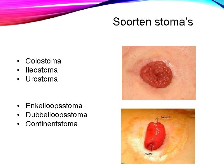 Soorten stoma’s • Colostoma • Ileostoma • Urostoma • Enkelloopsstoma • Dubbelloopsstoma • Continentstoma