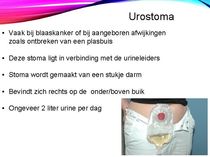 Urostoma • Vaak bij blaaskanker of bij aangeboren afwijkingen zoals ontbreken van een plasbuis