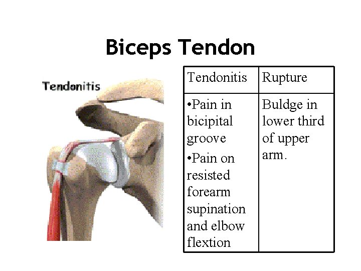 Biceps Tendonitis Rupture • Pain in bicipital groove • Pain on resisted forearm supination