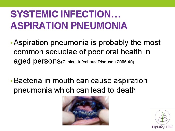 SYSTEMIC INFECTION… ASPIRATION PNEUMONIA • Aspiration pneumonia is probably the most common sequelae of