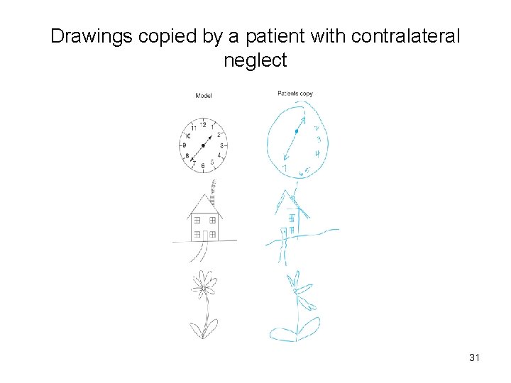 Drawings copied by a patient with contralateral neglect 31 