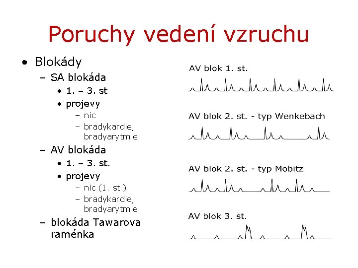 Poruchy vedení vzruchu • Blokády – SA blokáda • 1. – 3. st •