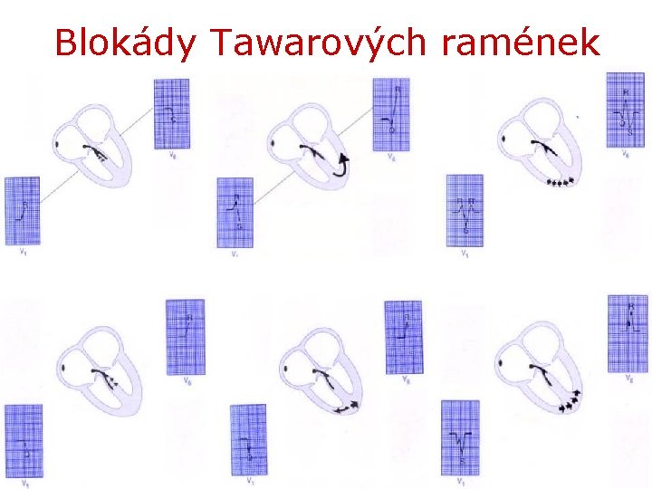 Blokády Tawarových ramének 