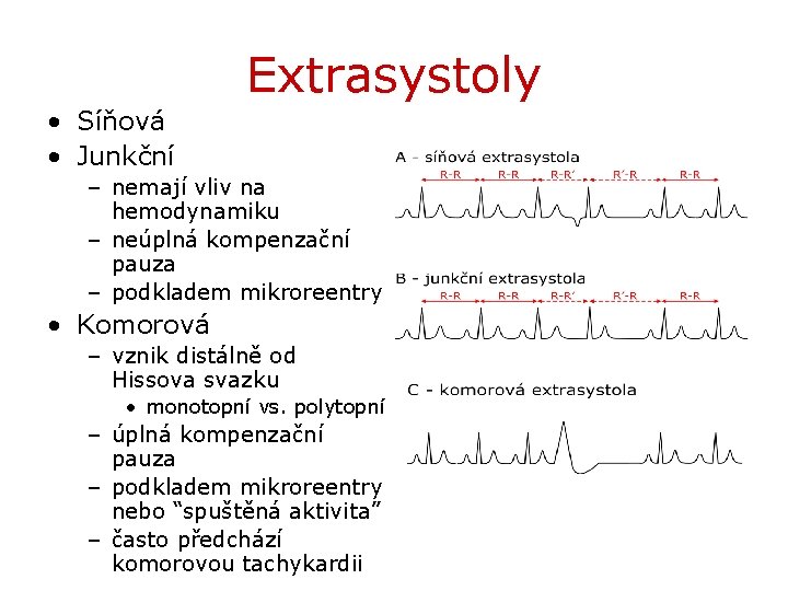 Extrasystoly • Síňová • Junkční – nemají vliv na hemodynamiku – neúplná kompenzační pauza