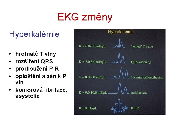 EKG změny Hyperkalémie • • hrotnaté T vlny rozšíření QRS prodloužení P-R oploštění a