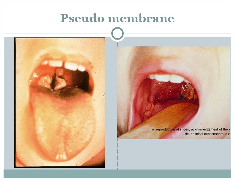 Pseudo membrane 