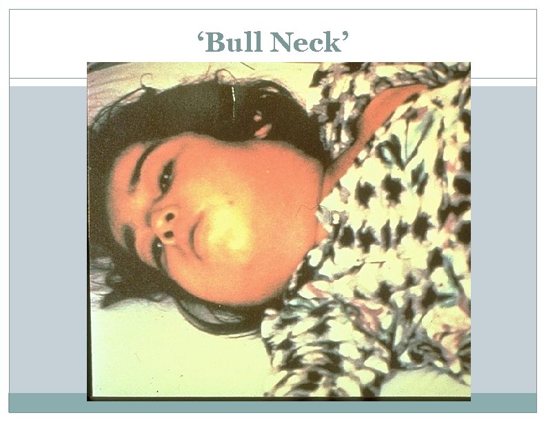 ‘Bull Neck’ 