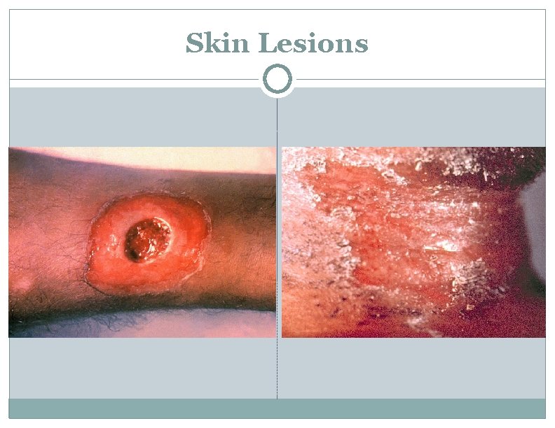 Skin Lesions 