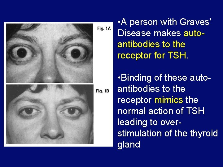  • A person with Graves’ Disease makes autoantibodies to the receptor for TSH.
