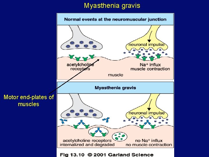 Myasthenia gravis Motor end-plates of muscles 