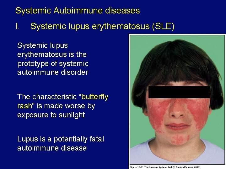 Systemic Autoimmune diseases I. Systemic lupus erythematosus (SLE) Systemic lupus erythematosus is the prototype