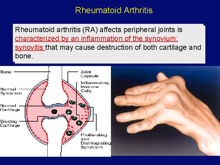 Rheumatoid Arthritis Rheumatoid arthritis (RA) affects peripheral joints is characterized by an inflammation of