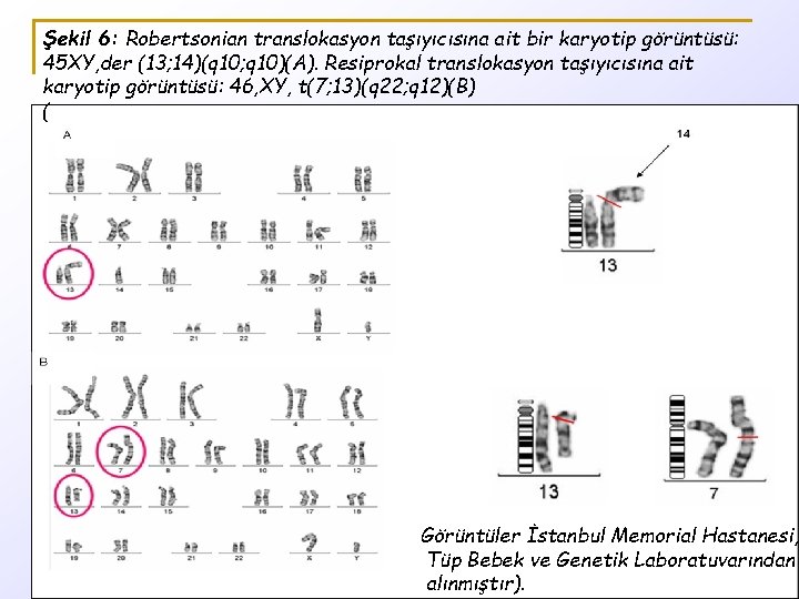 Şekil 6: Robertsonian translokasyon taşıyıcısına ait bir karyotip görüntüsü: 45 XY, der (13; 14)(q