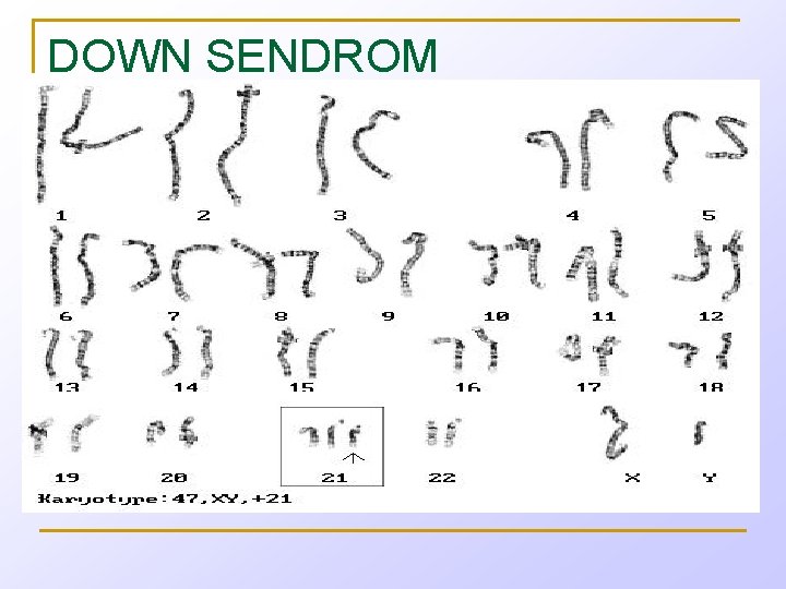 DOWN SENDROM 