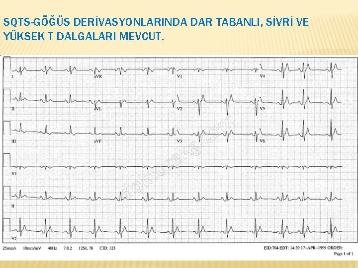 SQTS-GÖĞÜS DERİVASYONLARINDA DAR TABANLI, SİVRİ VE YÜKSEK T DALGALARI MEVCUT. 