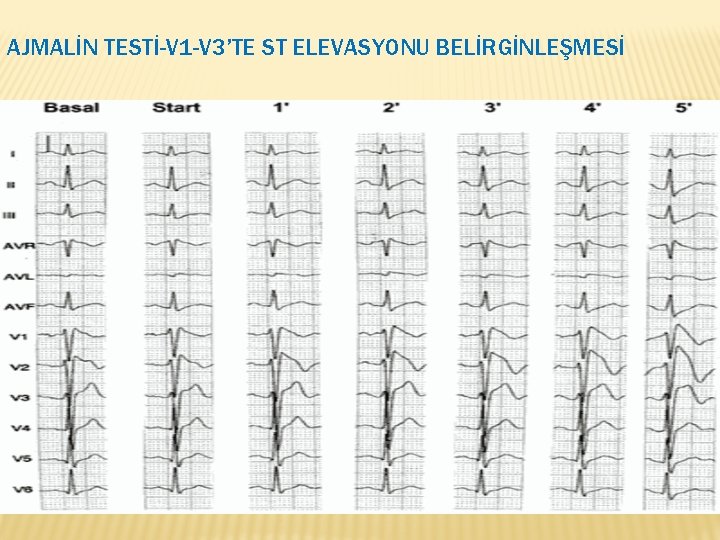 AJMALİN TESTİ-V 1 -V 3’TE ST ELEVASYONU BELİRGİNLEŞMESİ 