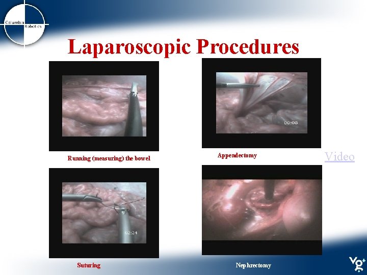 Laparoscopic Procedures Running (measuring) the bowel Suturing Appendectomy Nephrectomy Video 