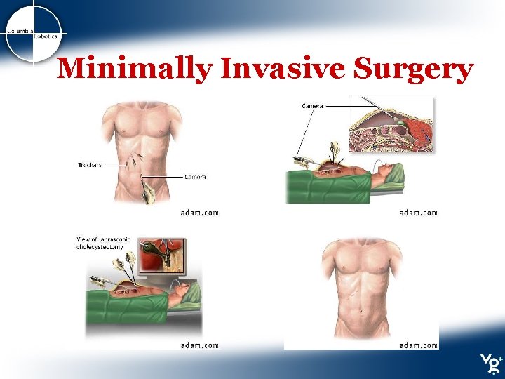 Minimally Invasive Surgery 