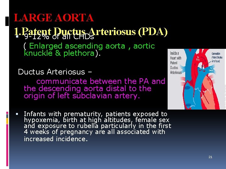 LARGE AORTA 1. Patent Ductus Arteriosus (PDA) 9 -12% of all CHDs ( Enlarged