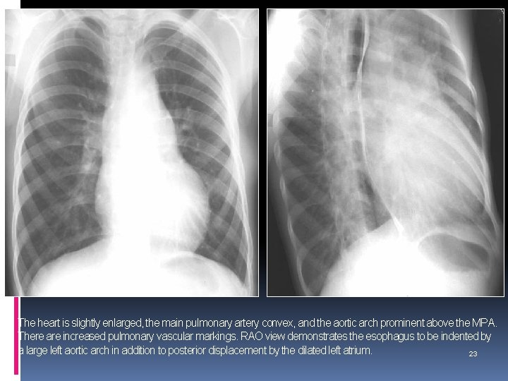 The heart is slightly enlarged, the main pulmonary artery convex, and the aortic arch