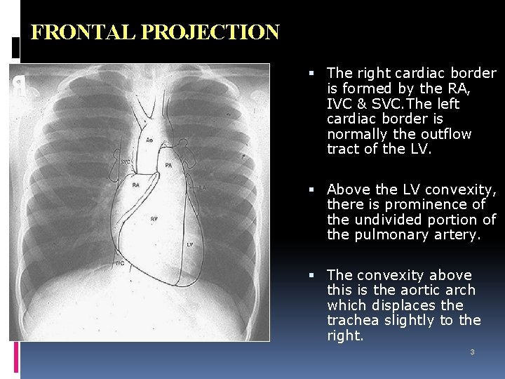 FRONTAL PROJECTION The right cardiac border is formed by the RA, IVC & SVC.