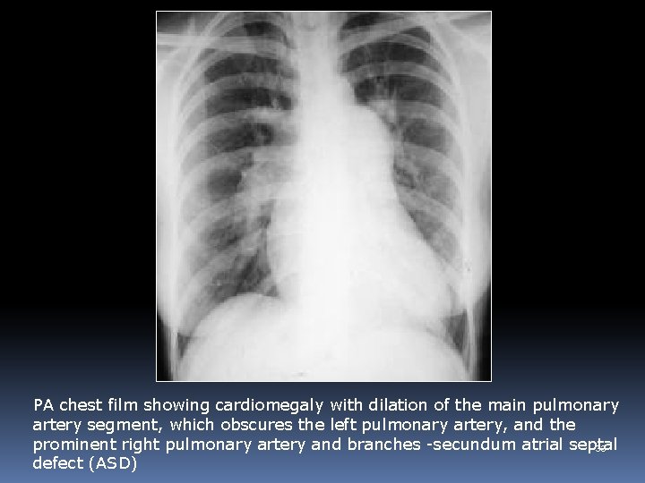 PA chest film showing cardiomegaly with dilation of the main pulmonary artery segment, which