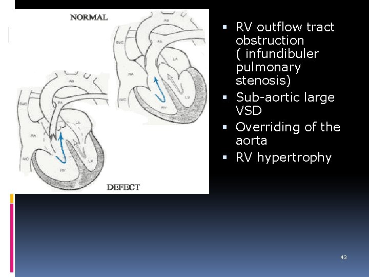  RV outflow tract obstruction ( infundibuler pulmonary stenosis) Sub-aortic large VSD Overriding of