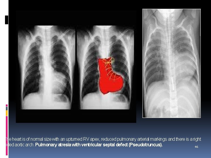 The heart is of normal size with an upturned RV apex, reduced pulmonary arterial