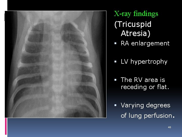X-ray findings (Tricuspid Atresia) RA enlargement LV hypertrophy The RV area is receding or