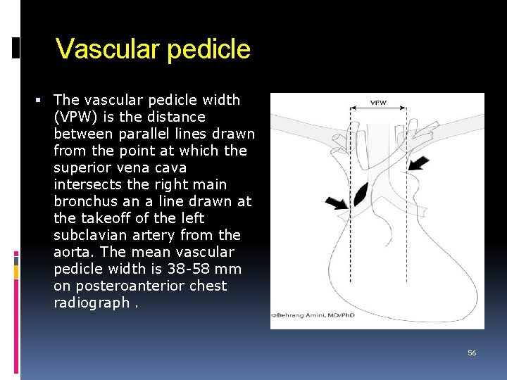 Vascular pedicle The vascular pedicle width (VPW) is the distance between parallel lines drawn