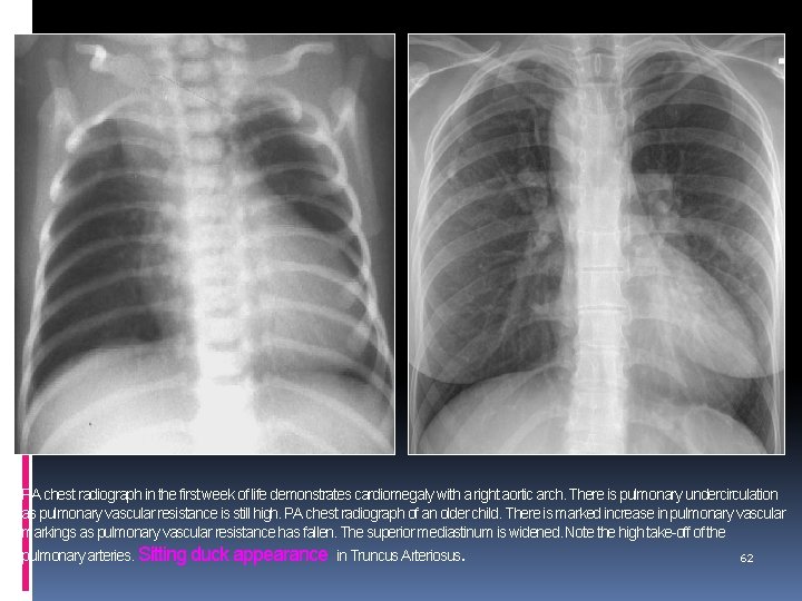 PA chest radiograph in the first week of life demonstrates cardiomegaly with a right