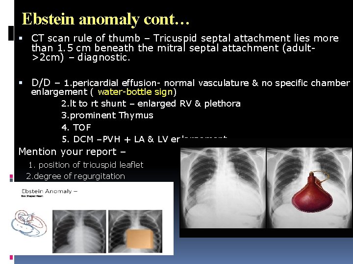 Ebstein anomaly cont… CT scan rule of thumb – Tricuspid septal attachment lies more