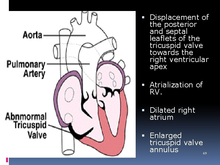  Displacement of the posterior and septal leaflets of the tricuspid valve towards the