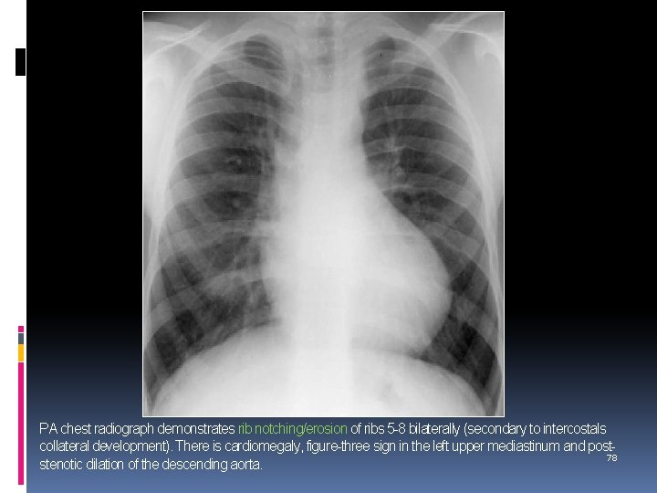 PA chest radiograph demonstrates rib notching/erosion of ribs 5 -8 bilaterally (secondary to intercostals