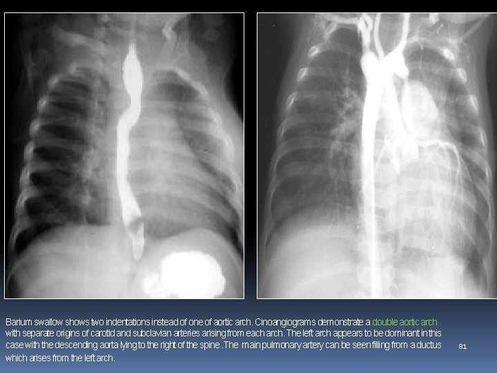 Barium swallow shows two indentations instead of one of aortic arch. Cinoangiograms demonstrate a