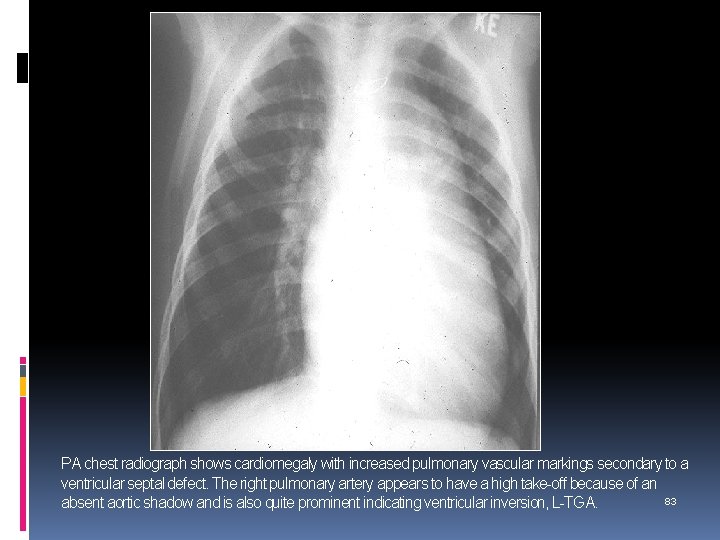 PA chest radiograph shows cardiomegaly with increased pulmonary vascular markings secondary to a ventricular