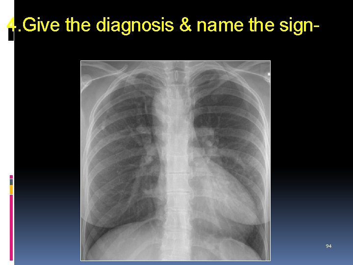 4. Give the diagnosis & name the sign- 94 